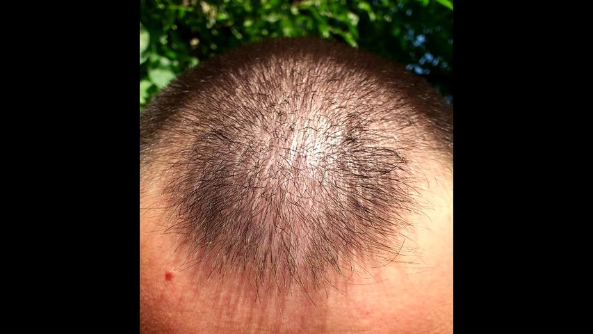 Minoxidil hair regrowth results before and after 9 months, with lots of  pictures 2013 - video Dailymotion