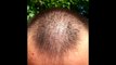 Minoxidil hair regrowth results before and after 9 months, with lots of pictures 2013