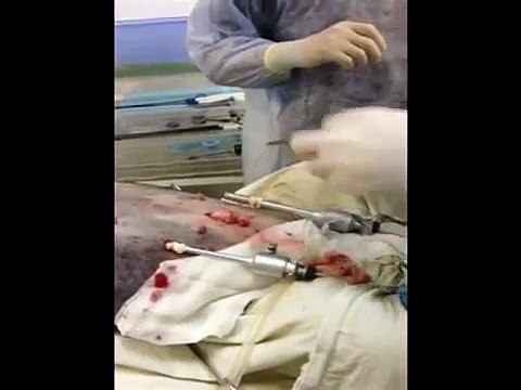 Laparoscopic -guided peritoneal tubes placement in dog