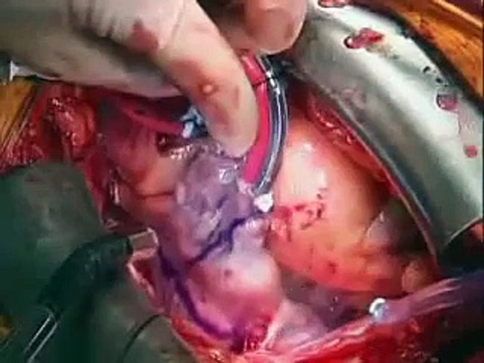 Podcast: CryoMaze Procedure, a Surgical Treatment for Atrial Fibrilation