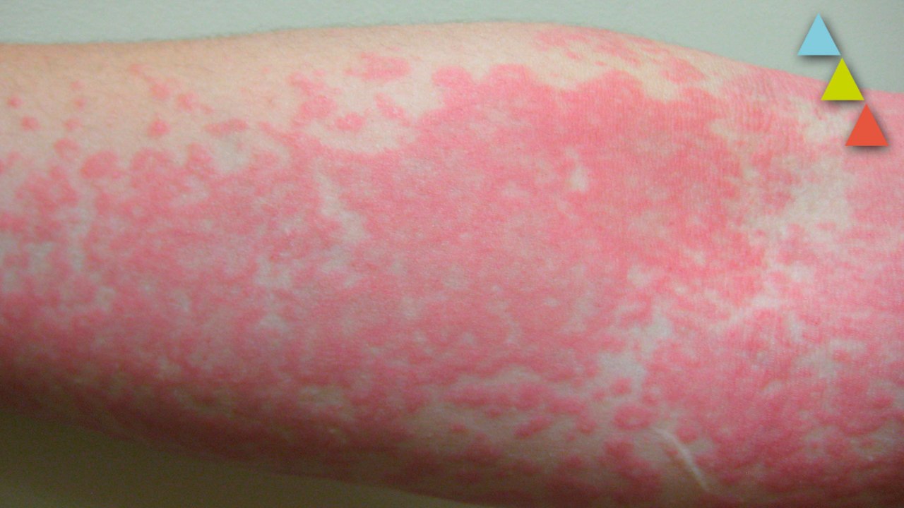 Las 10 alergias más raras del mundo