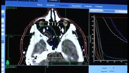 Napoli - Il "Pascale" getta le basi per la radioterapia a protoni (30.07.15)