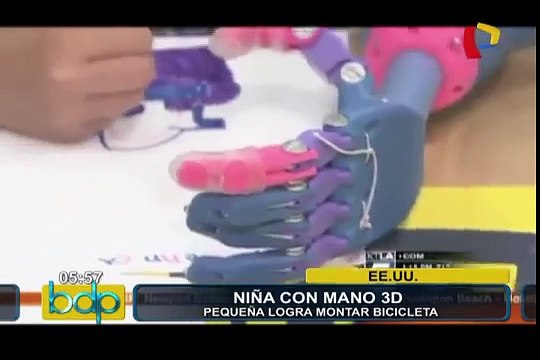 Niña recibe prótesis de mano realizada con impresión 3D