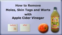 How to Remove Moles, Skin Tags and Warts Naturally