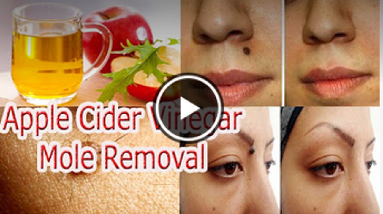 Apple Cider Vinegar Mole Removal video Dailymotion