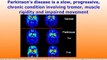Parkinsons Disease Symptoms Reversed