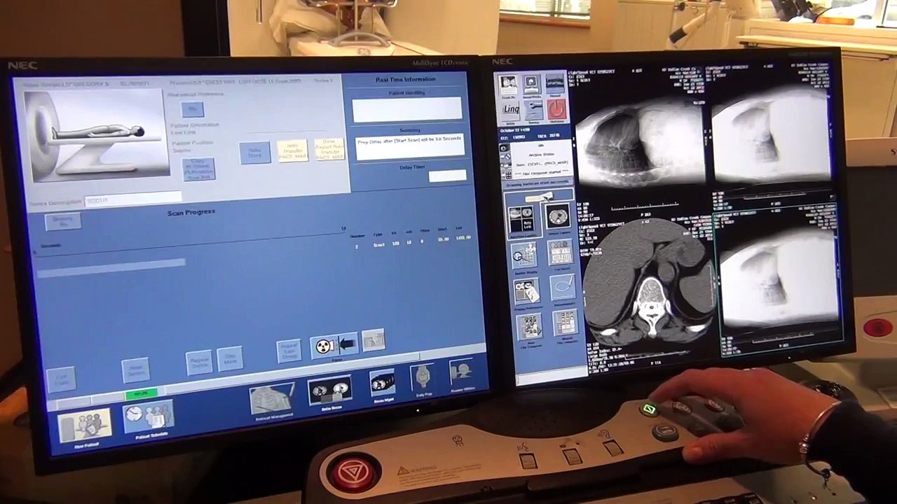 Low Dose Lung Screening