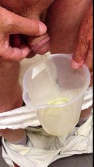 Bağırsaktan Yapay Mesane Ameliyatı 2 Ay Sonrası Hasta Gözlemi - Prof. Dr. Tahir Karadeniz