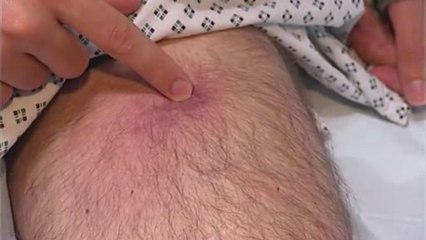 Guêpes: les hôpitaux et les pompiers sont submergés