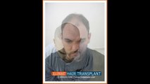 how to find best video of FUE hair transplant surgery in Pakistan?