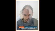 how to find best video of FUE hair transplant surgery in Pakistan?