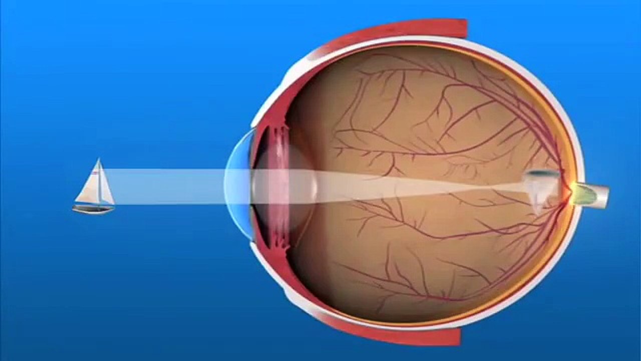 Refractive Errors