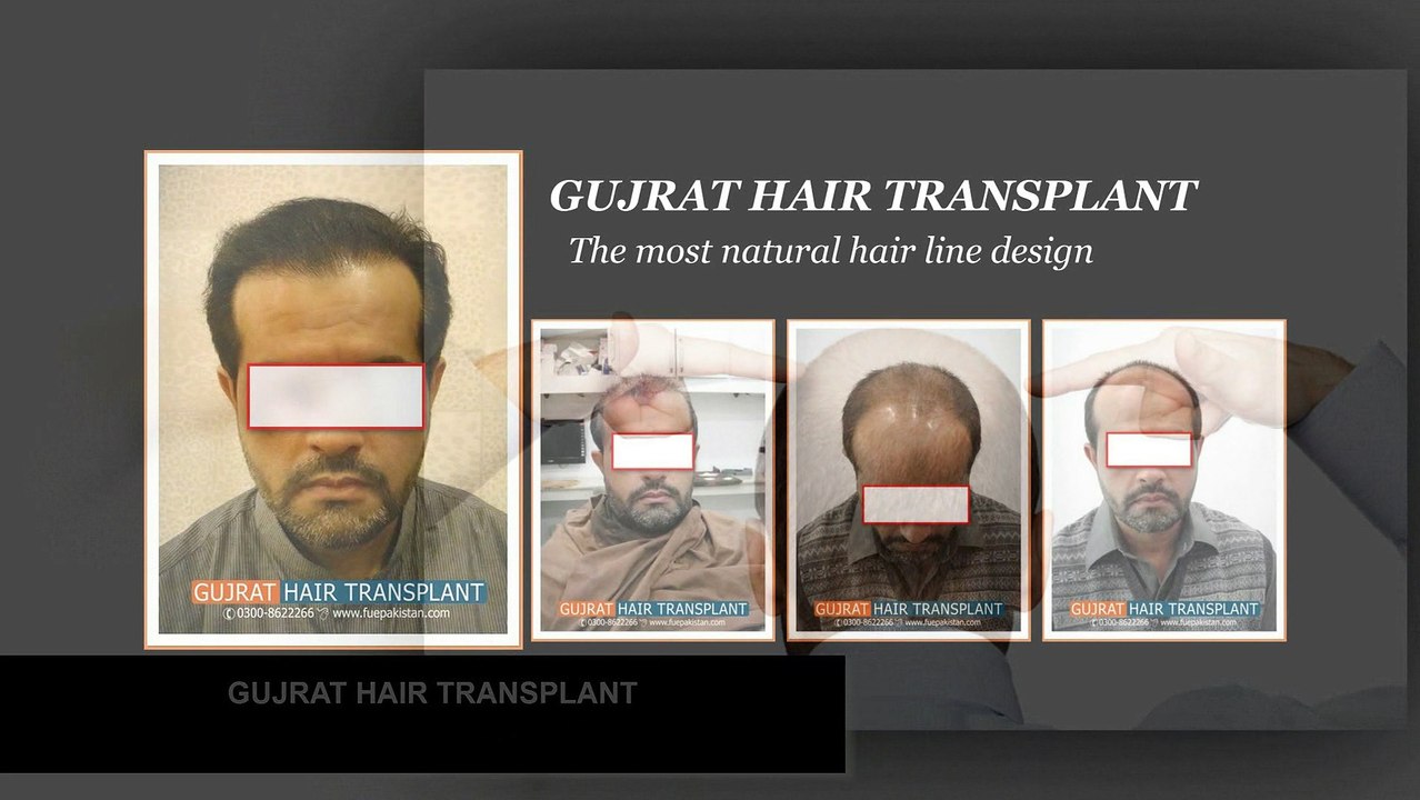 Video demonstration of FUE Hair transplant in Pakistan,Best quality hair transplant center in pakistan