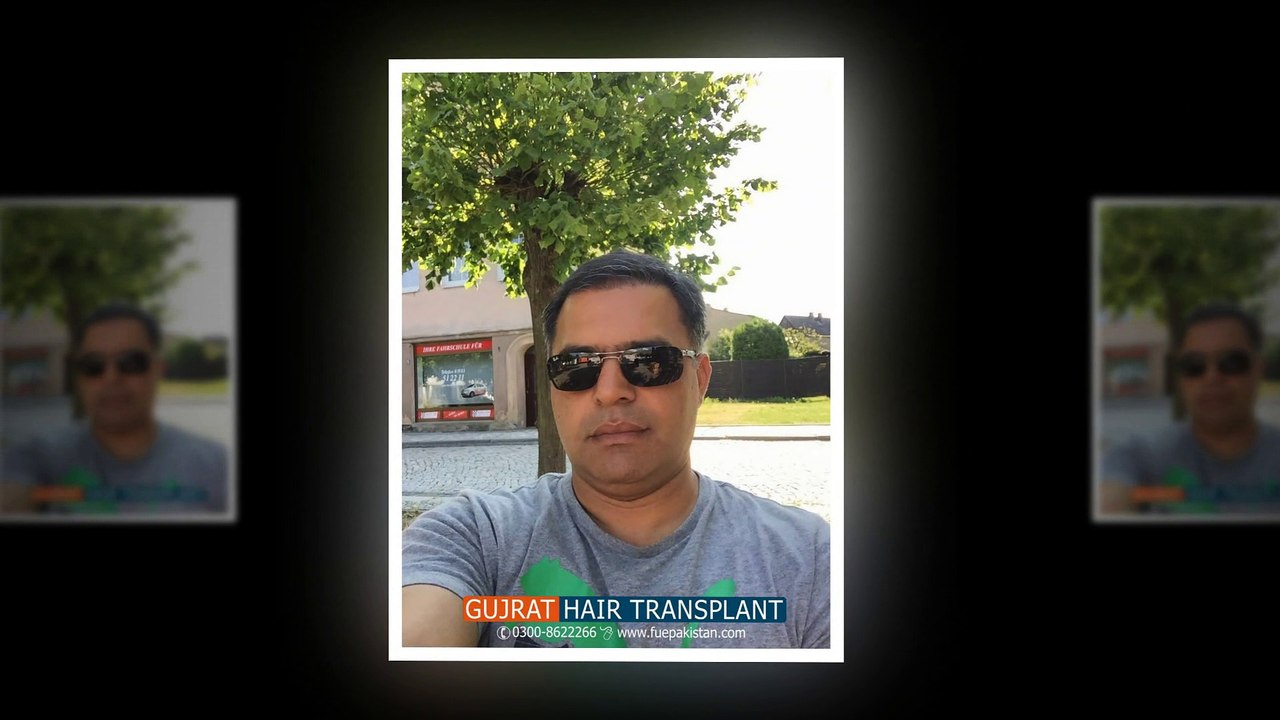 celebrities hair transplant clinic in Pakistan,FUE hair transplant clinic with affordable price.