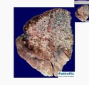 Histopathology Lung, lymph node --Bronchioloalveolar carcino
