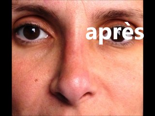 rhinoplastie secondaire avec implant par Vladimir Mitz