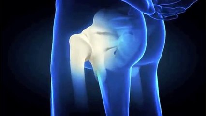 Johnson & Johnson Hip Implant Recall Explained by Orthopedic Surgeon