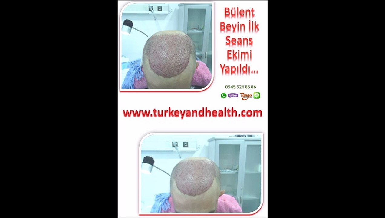 SAÇ EKİM ÖNCESİ SONRASI, İSTANBUL SAÇ EKİM MERKEZİ, İstanbul hair, haircenter, Hair Transplant Center