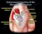 Shoulder bursitis, Tendonitis Injection Animation - Everything You Need To Know - Dr. Nabil Ebraheim