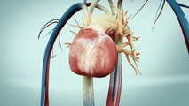 TAVI transfemoral - Transcatheter Aortic Heart Valve - Animation