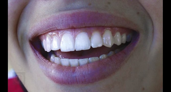 Tut Photoshop# How to whiten teeth photoshop tutorial