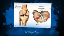 Cartilage Tear (Torn Meniscus) Limerick Pain Relief and Sports Injury Clinic