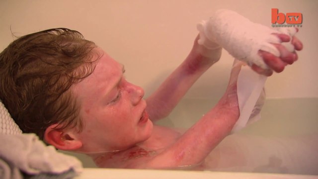 Ce garçon perd sa peau lorsqu'on le touche... Maladie rare Papillon