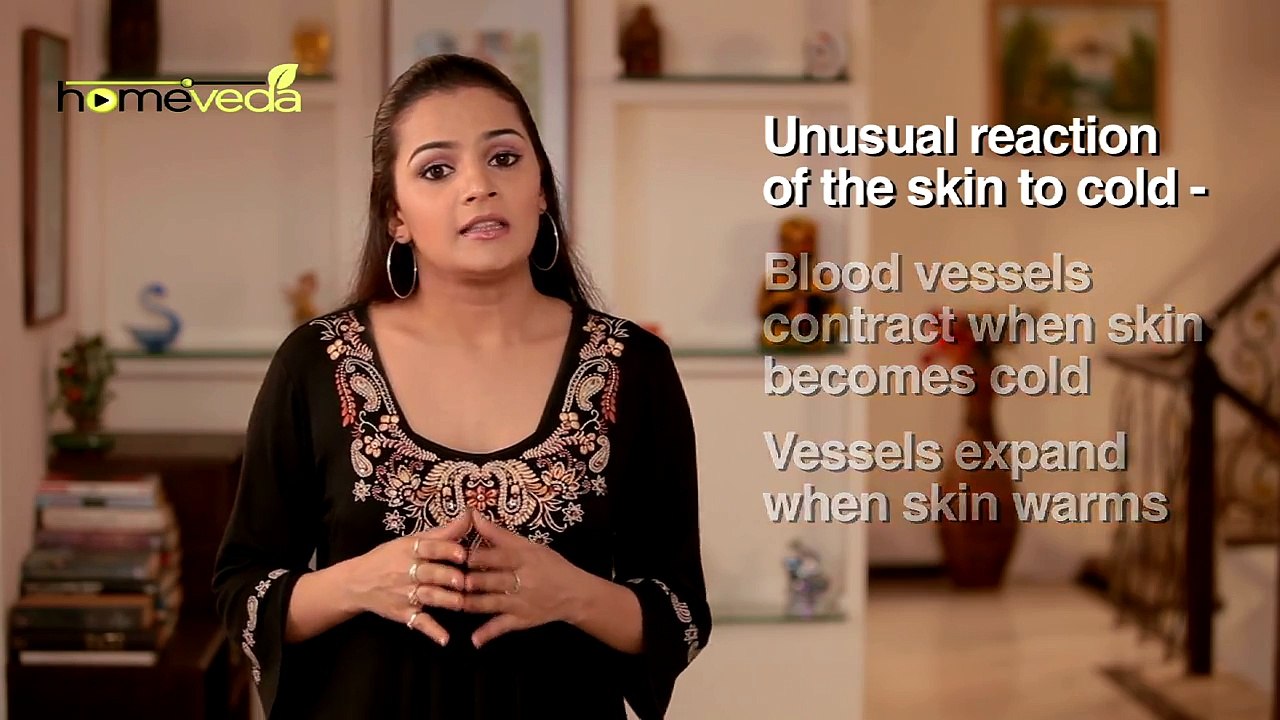 Chilblain - Natural Ayurvedic Home Remedies