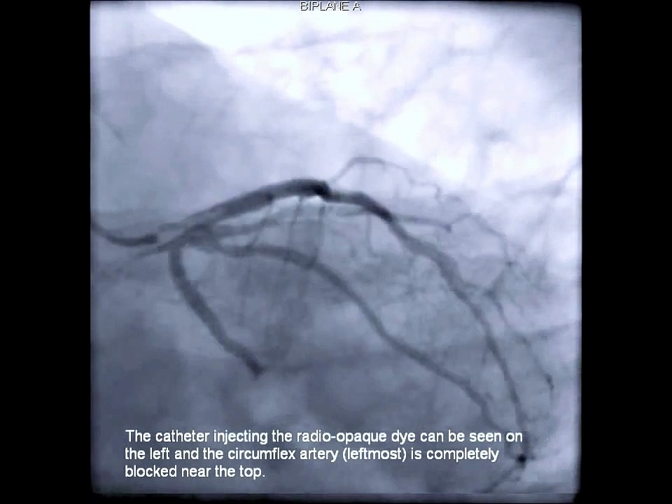 My Angioplasty and Stent insertion