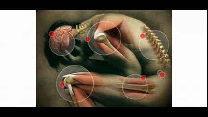 Somatoform Disorders