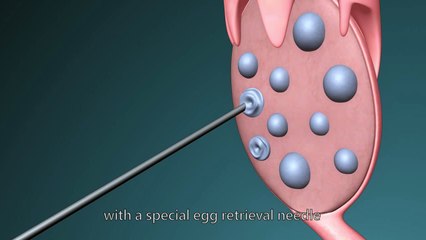 Ivf, ivf process, ivf procedure, ivf process in detail, ivf process step by step - IVF animation