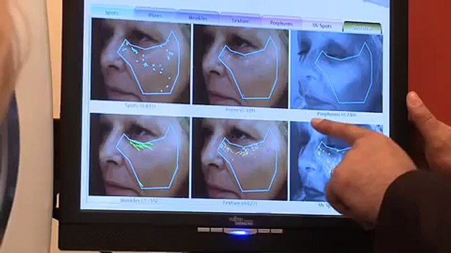 Save £100 on Botox Treatment | Special Offer at Harley Street Skin Clinic