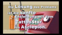 Tattooentfernung mittels Q-Switch-Laser von Asclepion