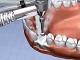 Dr Rodney Aziz - Dental Implant Animation Video