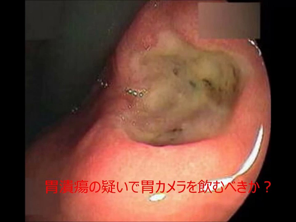 胃潰瘍の疑いで胃カメラを飲むべきか？
