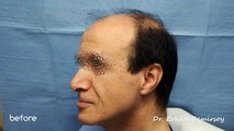 FUE Hair Transplant results - Dr. Erkan Demirsoy - 4050 Grafts