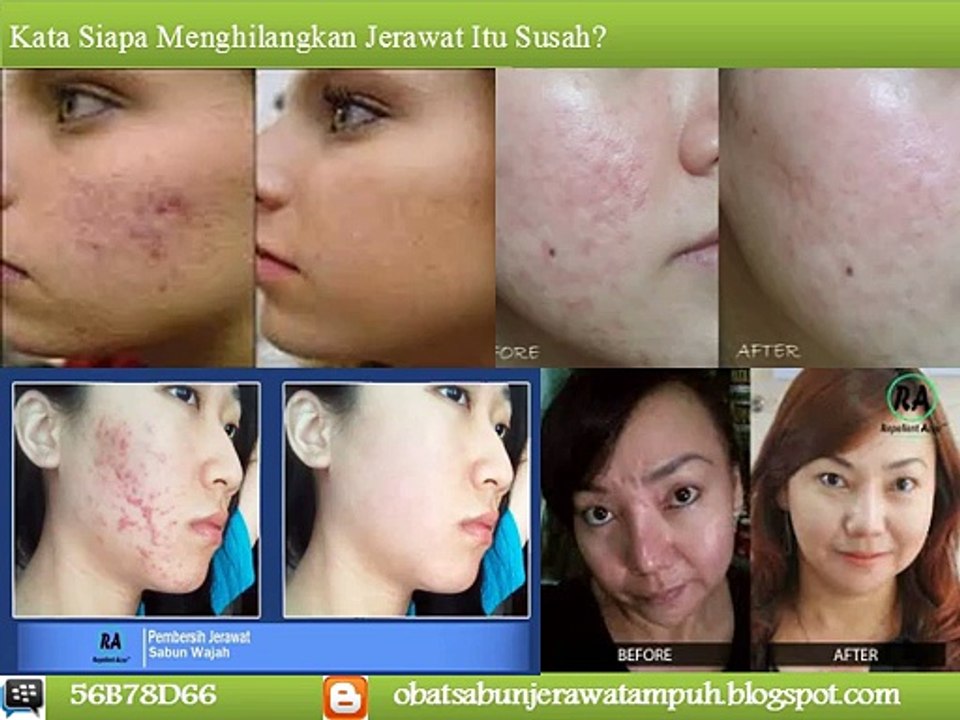 SMS 0858 7708 3892, Obat Penghilang Jerawat Bruntusan