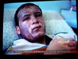 White Phosphorus Injuries - al Jazeera clip, broadcast January 21