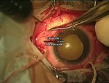 retinal surgery-pradeep v rao-AIIMS-endoillumination assisted scleral buckling surgery