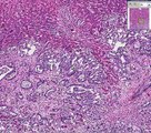 Histopathology Kidney, Liver, Heart--Pancreatic Carcinoma