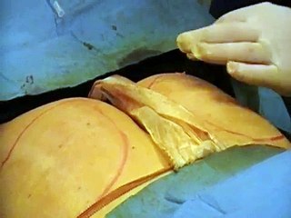 Fat Transfer-Buttocks