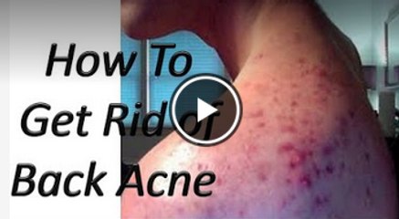 How To Get Rid of Back Acne