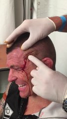 Quand le docteur s'amuse avec une plaie ouverte sur la tête d'un boxeur!