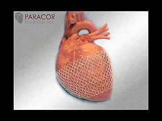 Enlarged Heart Animation