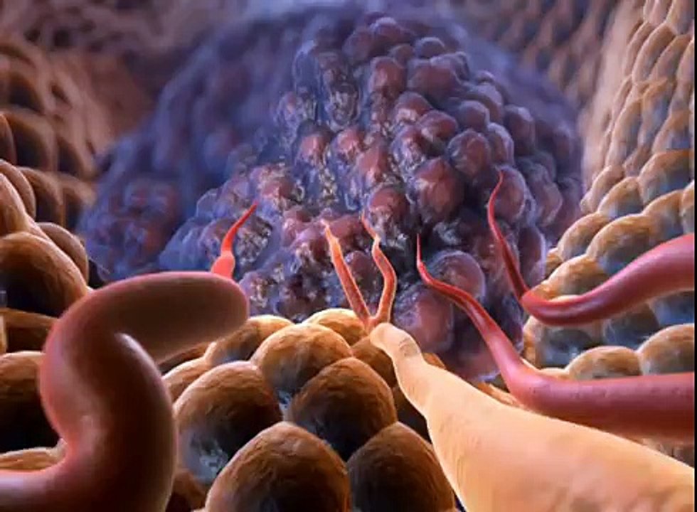 Pediatric Orthopedics: Osteomyelitis in Children