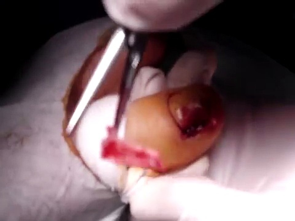 ingrown toenail Surgery (Onychocryptosis) - Wedge nail resection + matricectomy