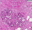 Histopathology Breast--Lobular carcinoma