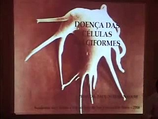 ANEMIA FALCIFORME - PARTE 1