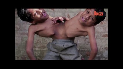 Conjoined twins