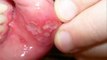 MOUTH ULCER , HEALTH EDUCATION , INFECTION CONTROL (ICSP) , URDU / HINDI